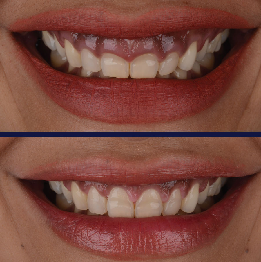 Emergency Dentists in Port Orchard Before and After