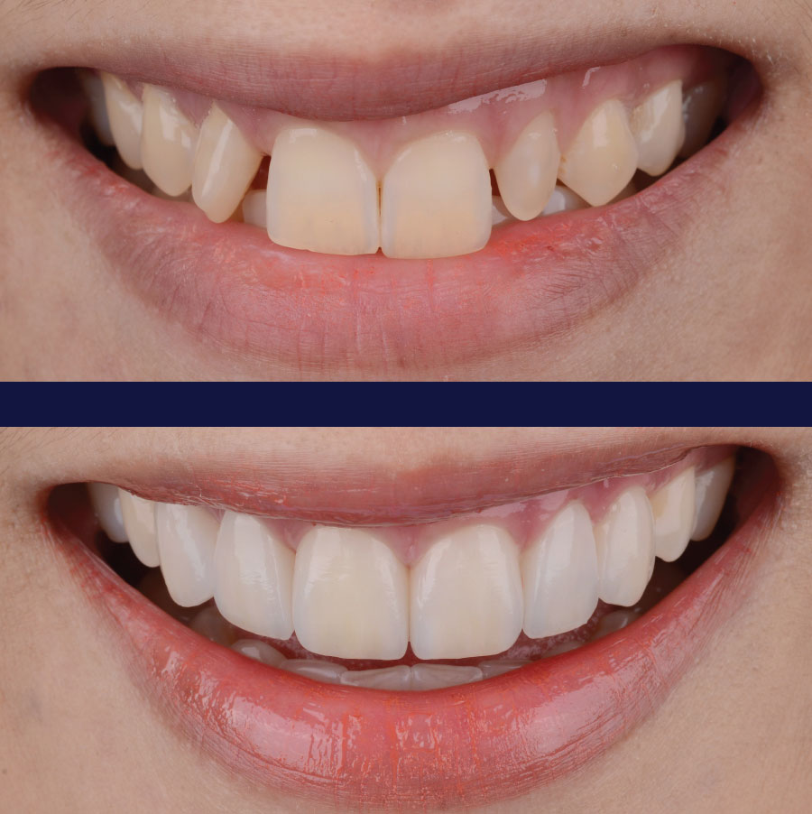 Emergency Dentists in Port Orchard Before and After