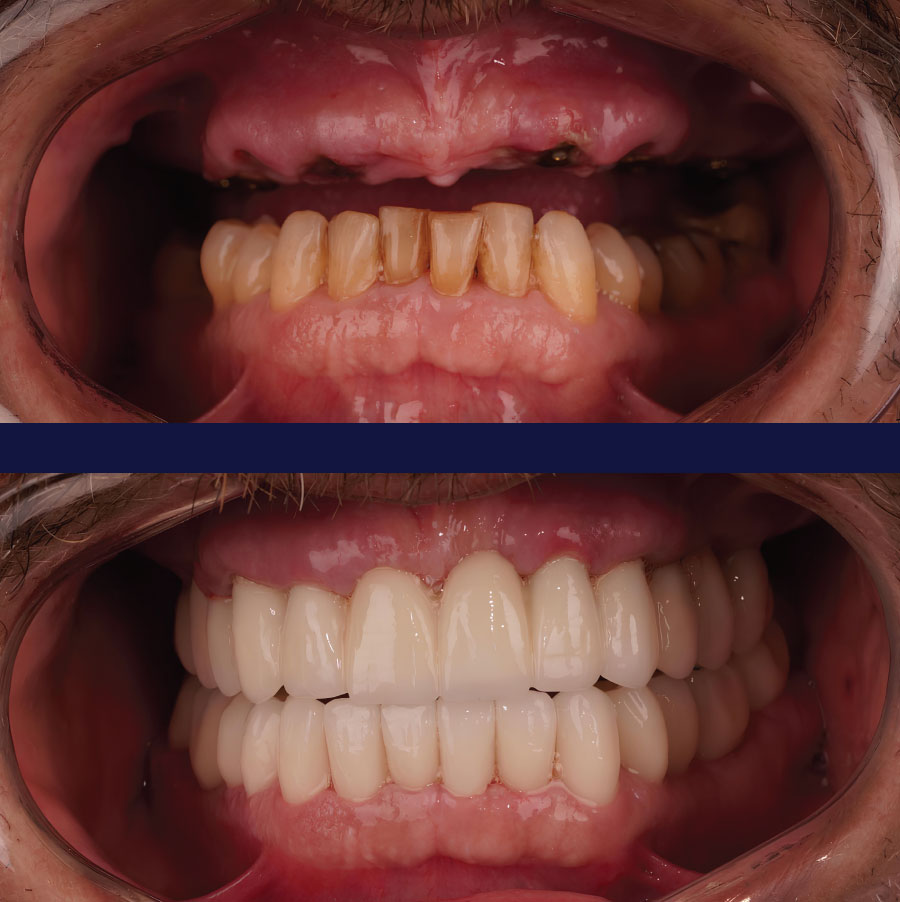 Emergency Dentists in Port Orchard Before and After