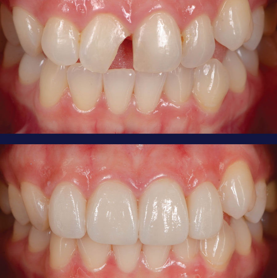 Emergency Dentists in Port Orchard Before and After
