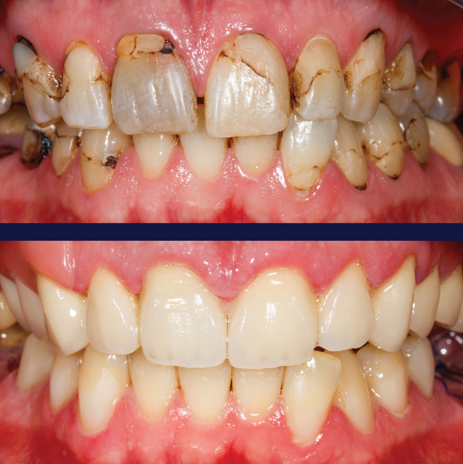 Emergency Dentists in Port Orchard Before and After