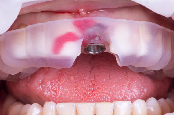 3D Printed Surgical Guide in Port Orchard